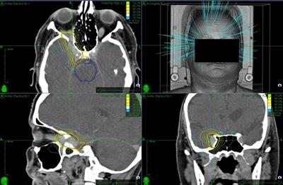 Robotic stereotactic radiosurgery for intracranial meningiomas in elderly patients: assessment of treatment efficacy and safety